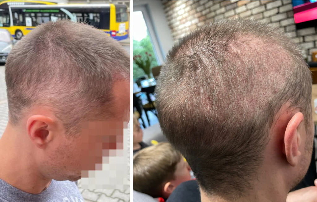 5 mjeseci nakon transplantacije kose pretjerana eksplantacija