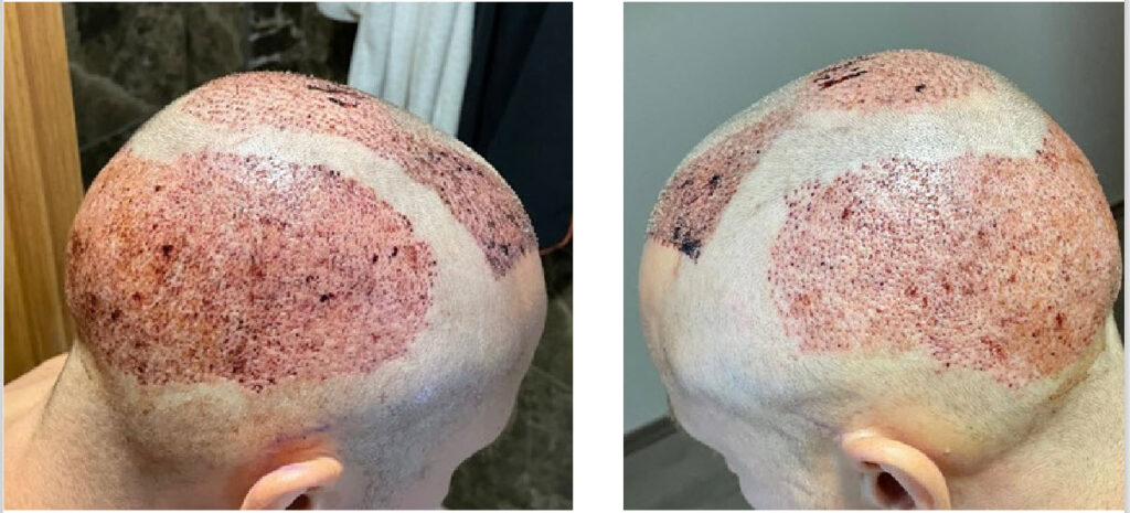 nakon transplantacije kose Turska