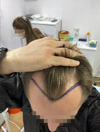 prije transplantacije kose nezakonita klinika
