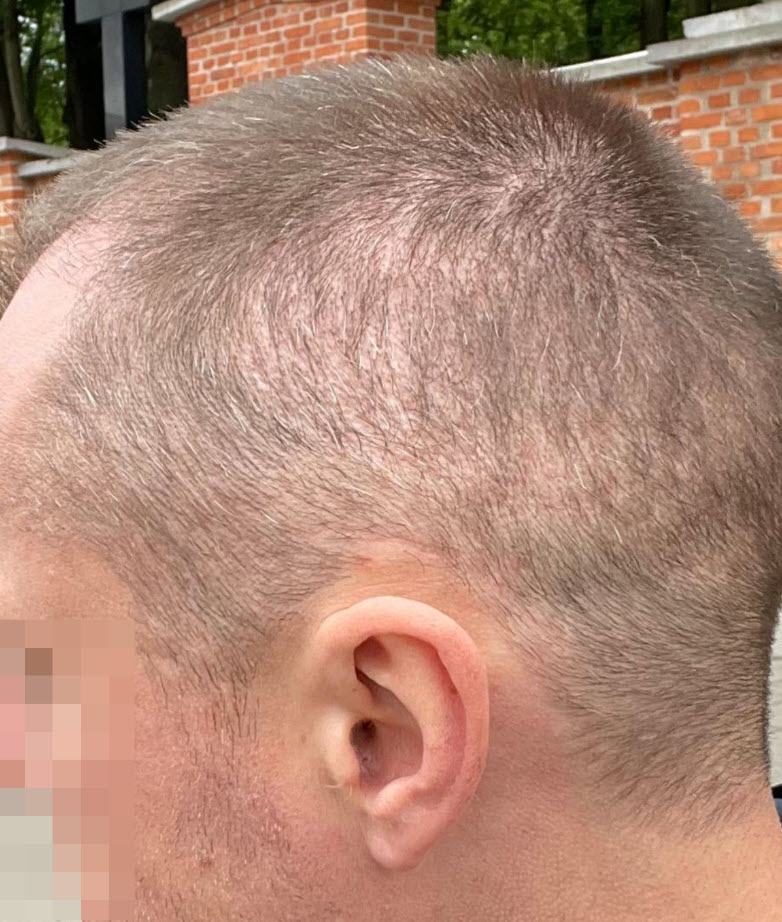 pretjerano iskorišteno donorsko područje transplantacije kose