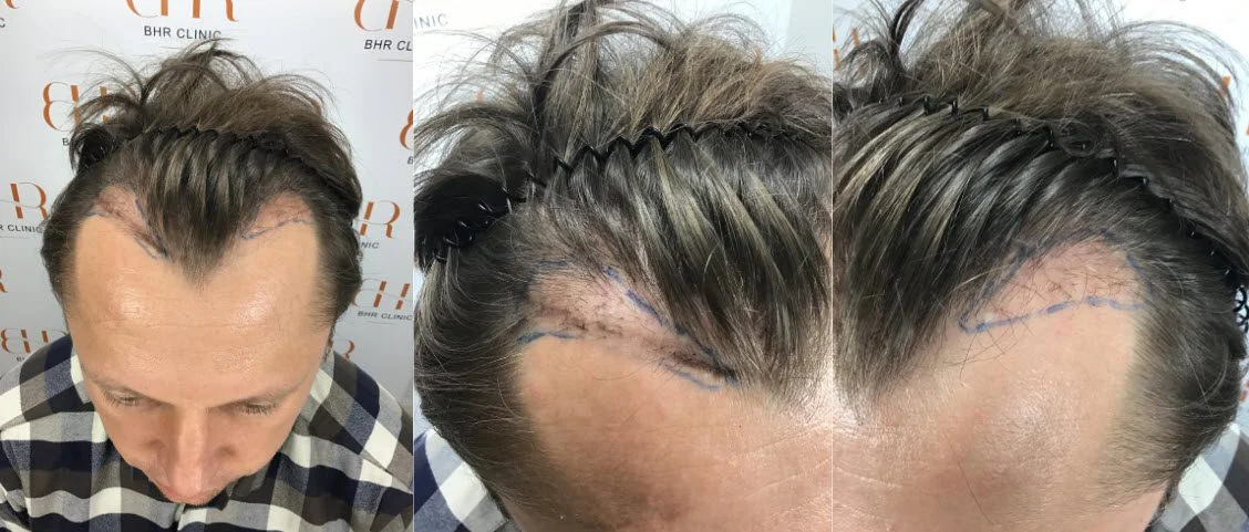 14 mjeseci nakon popravka transplantacije kose
